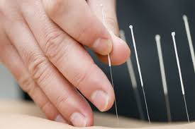 acupunctuur artrose
