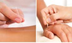 goede acupuncturist