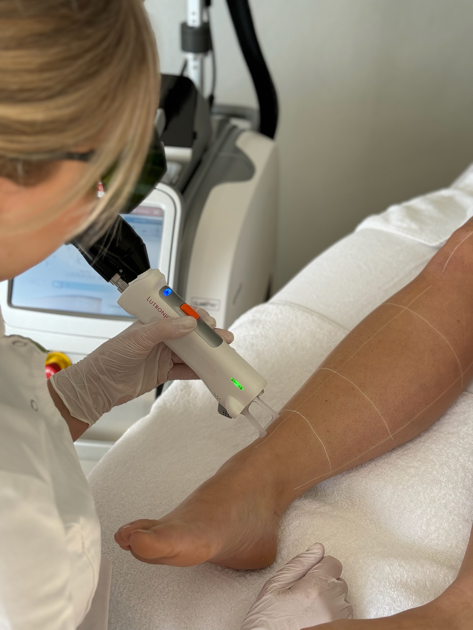 laser behandeling ontharen