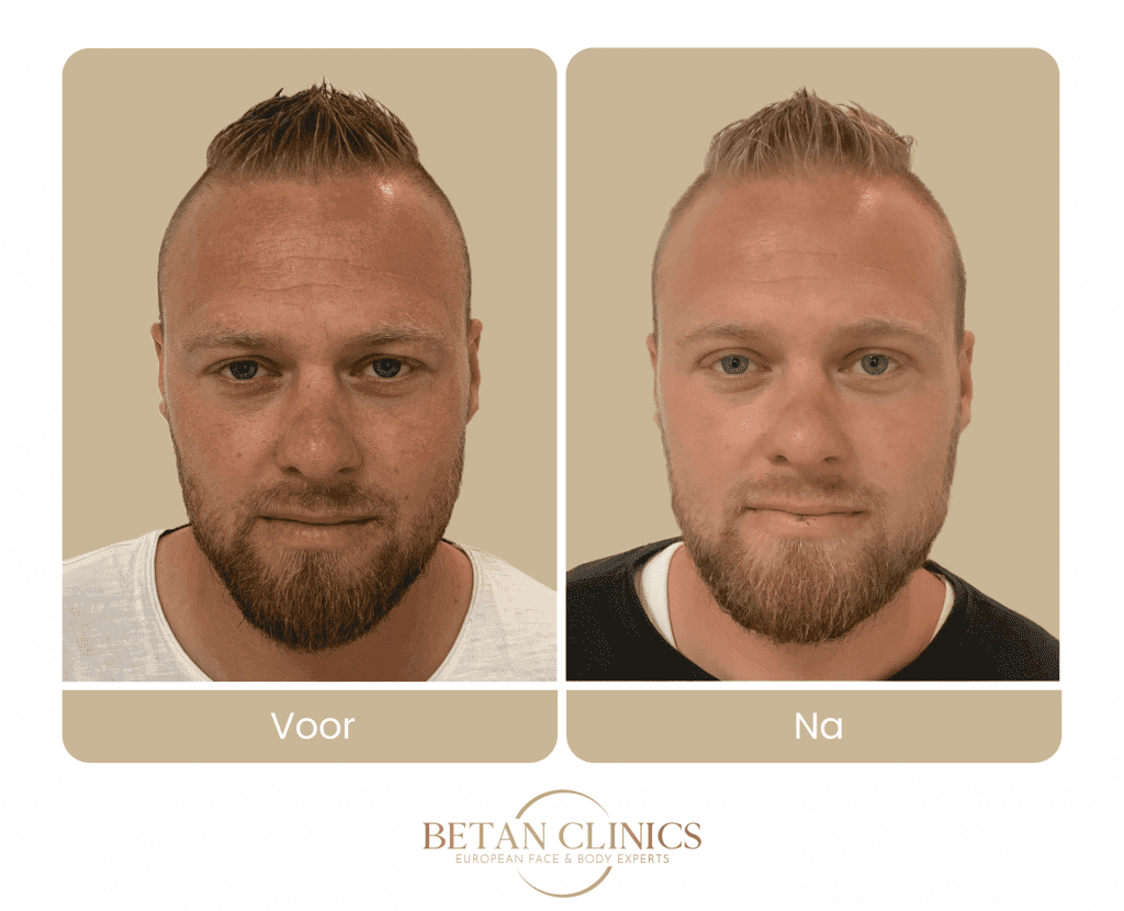bovenooglidcorrectie